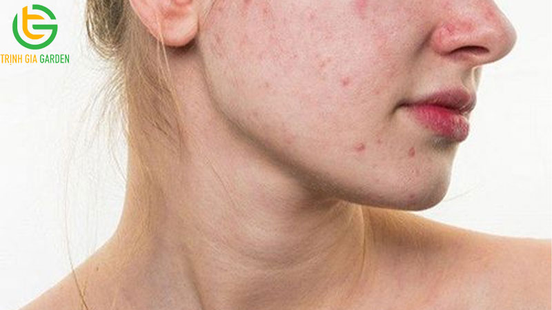 Cây sài đất: Đặc điểm, công dụng và bài thuốc 7 Cây sài đất: Đặc điểm, công dụng và bài thuốc